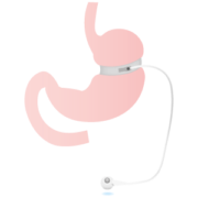 schéma anneau gastrique gastroplastie
