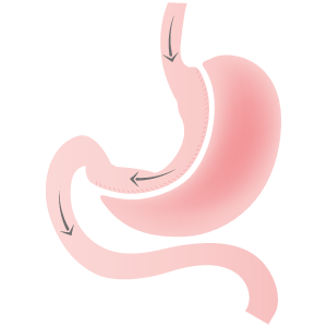 schéma sleeve gastrectomie